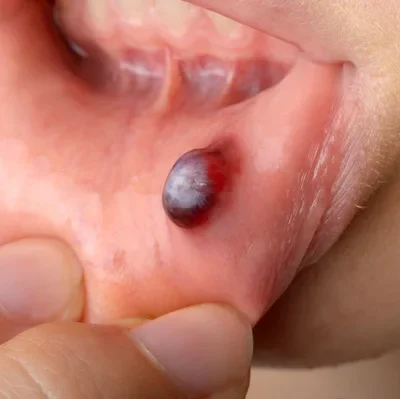 Blood Blister in Mouth: Causes, Symptoms, Treatment