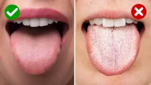white tongue causes treatments and prevention